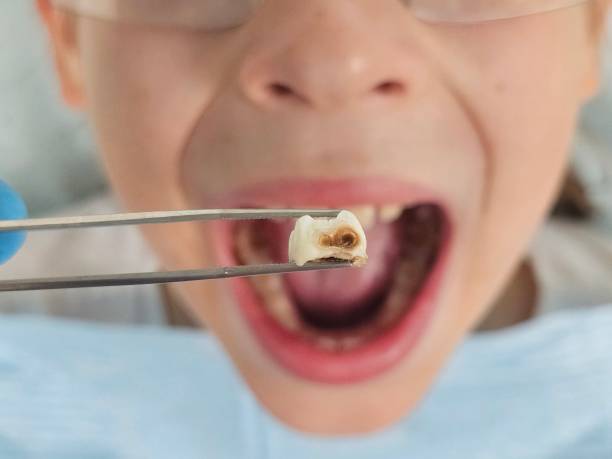 Best Broken or Cracked Tooth Emergency Dentist in Hialeah Gardens, FL
